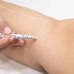 Ορισμός περιοχής αποτρίχωσης στα πόδια